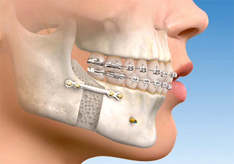 Cirurgia Ortognática - Instituto Maxilo Facial