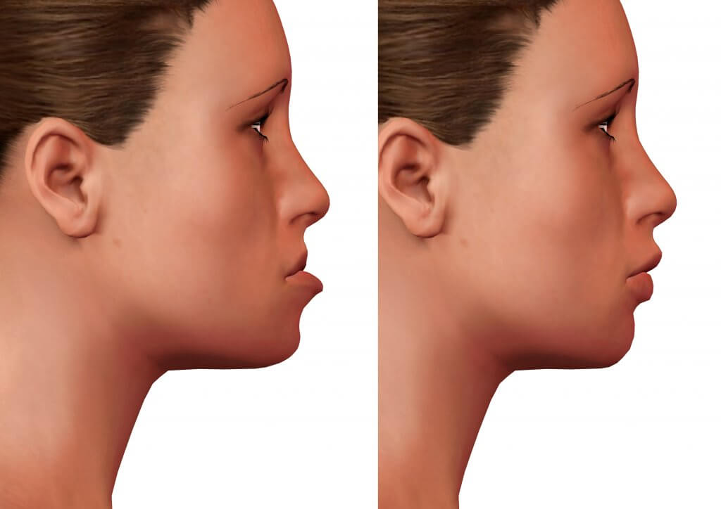 orthognathic surgery, correction of human mandible deformity, before and after, side view