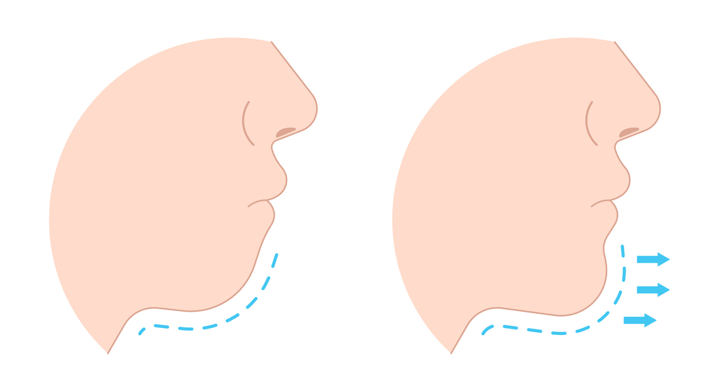 vantagens da cirurgia de mentoplastia